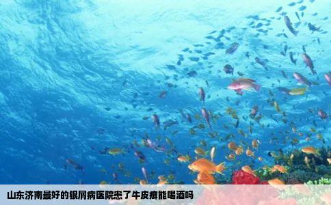 山东济南最好的银屑病医院患了牛皮癣能喝酒吗